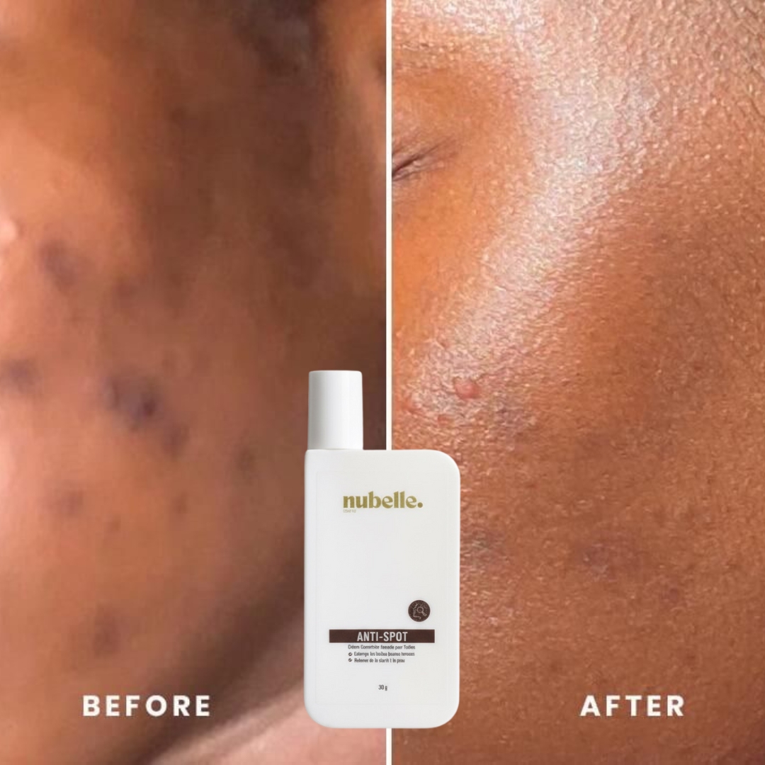 Antispot - Crème Ciblée pour Taches